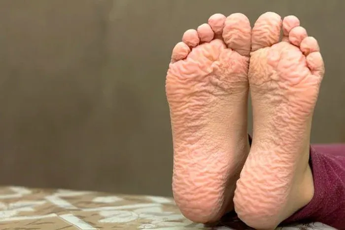 دلیل چروکیده شدن پوست