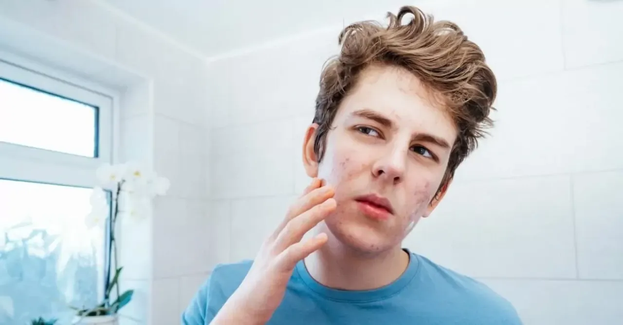 جوش های دوران نوجوانی